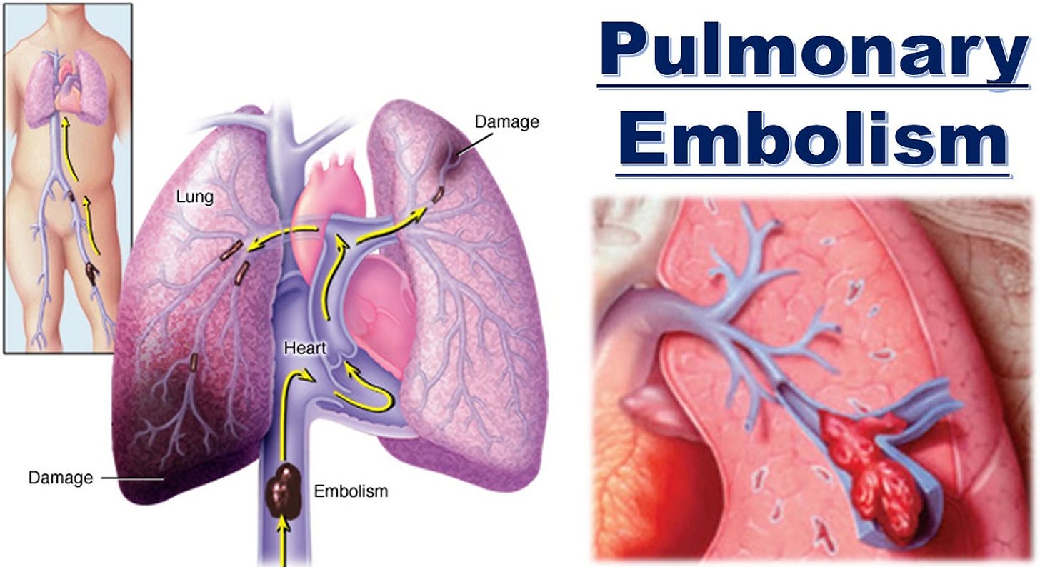 Pulmonary Embolism - Causes, Signs & Symptoms, Diagnosis, Treatment