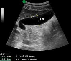Role of Point-of-Care Ultrasound (POCUS ...