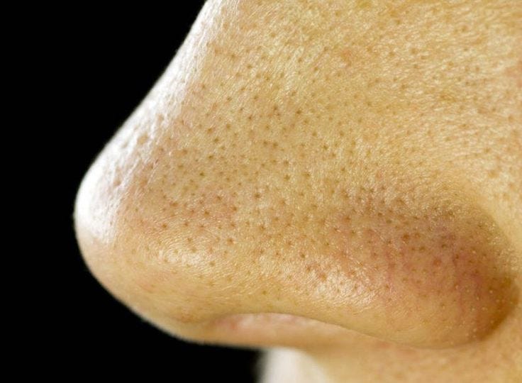 Sebaceous Filaments vs. Blackheads: What's The Difference?