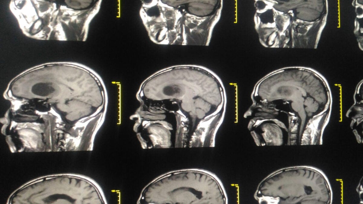 Major progress as scientists get brain tumors to self destruct