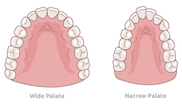 Palatal Expansion | Breathing Wellness | The Vivos System