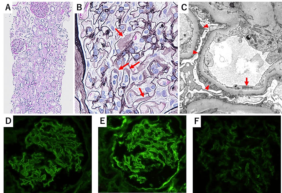 Histological-examination-of-the-kidney-biopsy.