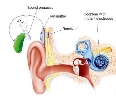 What is a cochlear implant? | Cochlear Implant Brain and Behavior Lab