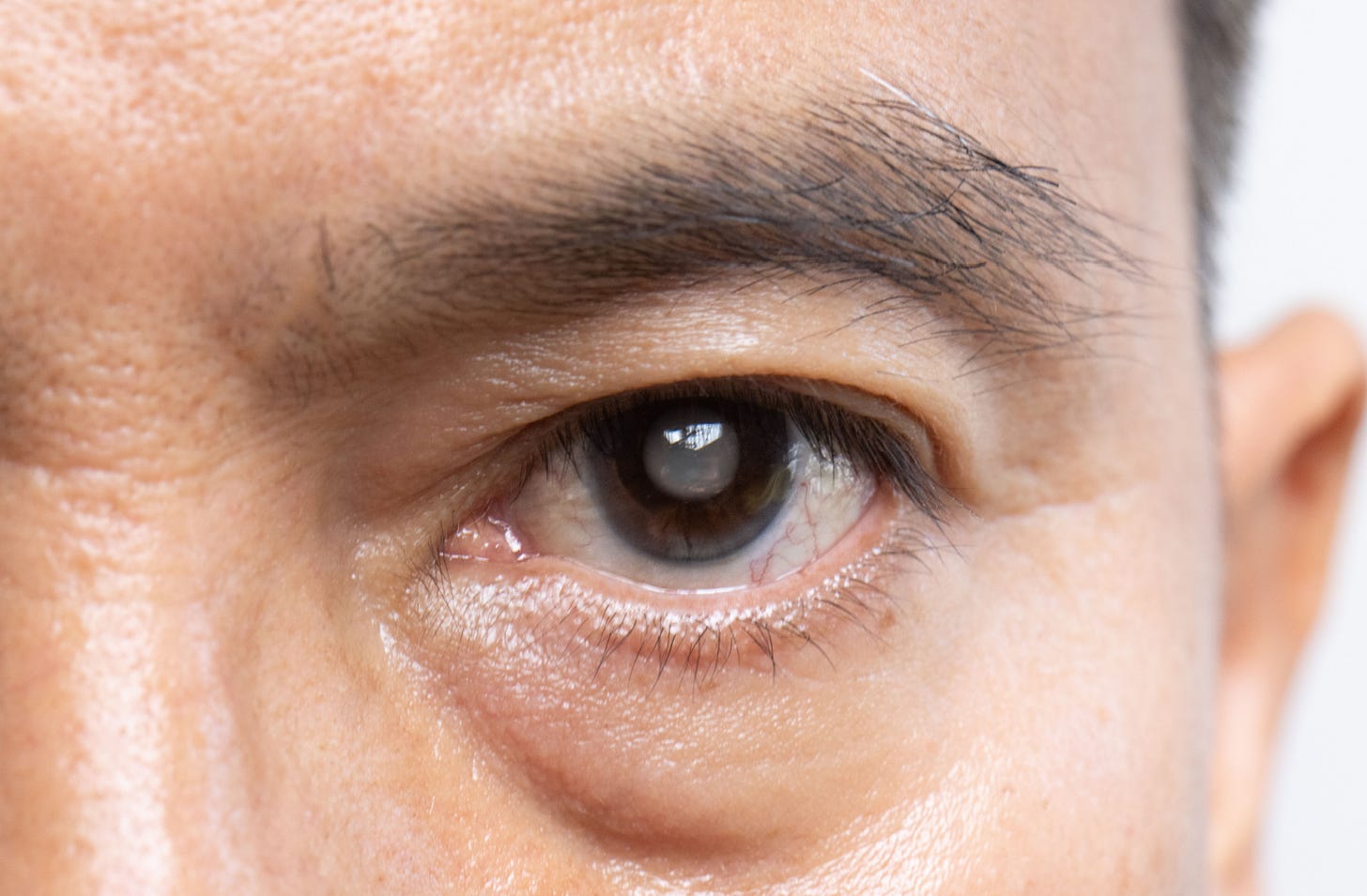 What's the Difference Between Cataracts & Glaucoma?