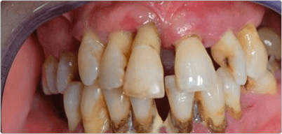 Gum Disease Treatment Ahmedabad | Perio Disease Treatment India
