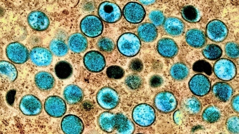 An image of mpox in blue and yellow.