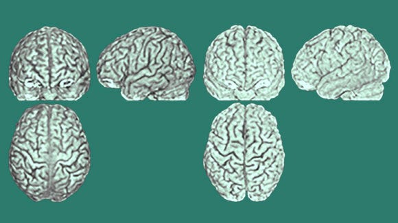 Three scans (from the front, side and above) of two different brains (pictured on the left and on the right) belonging to twins; the furrows and ridges are different in each person. Image credit: Lutz Jäncke, University of Zurich.