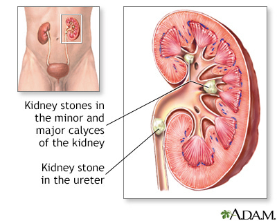 Kidney Stones (Nephrolithiasis) - Symptoms and Causes