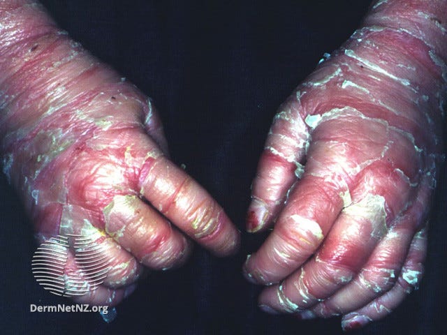 Picture of two small hands with reddened and pealing skin.