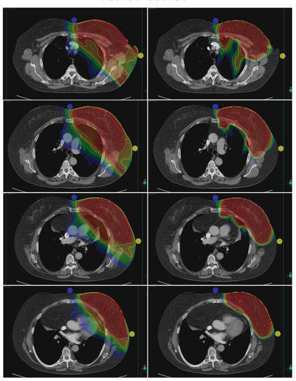 imrt proton comparison breast case mark storey md