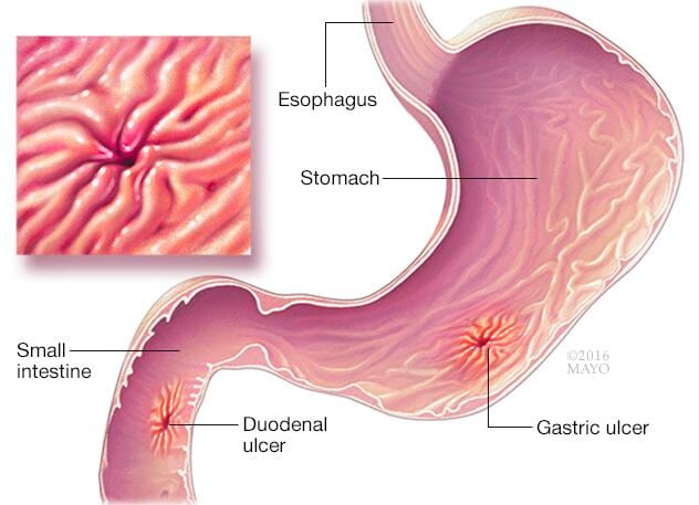 Helicobacter pylori (H. pylori) infection - Symptoms & causes - Mayo Clinic