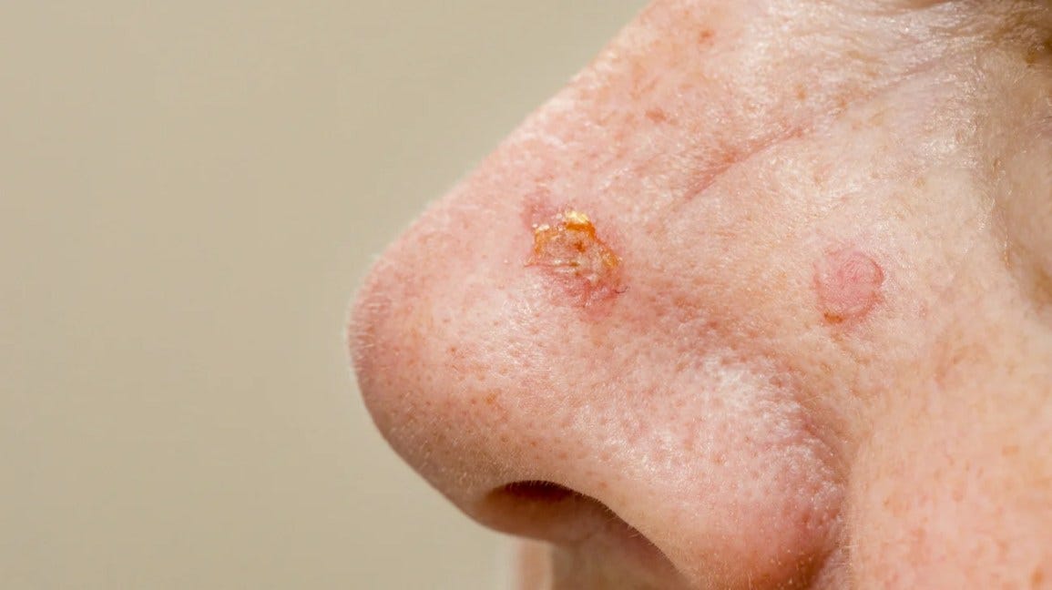 Skin Lesions: Pictures, Causes, Diagnosis, Treatment & More