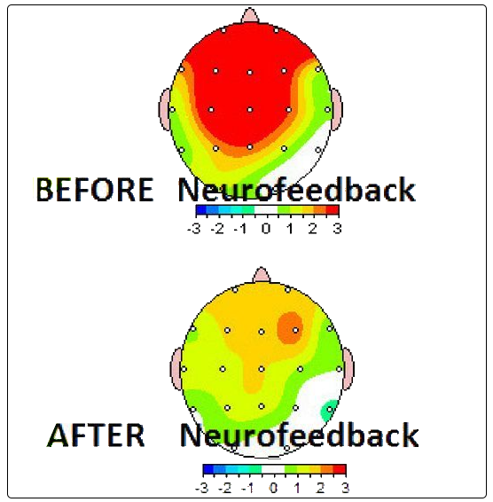 neurofeedback brain training neuropsychology relaxation meditation mindfulness therapy counseling lincoln stoller