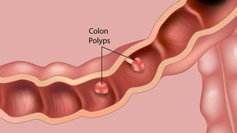 symptoms of colon polyps