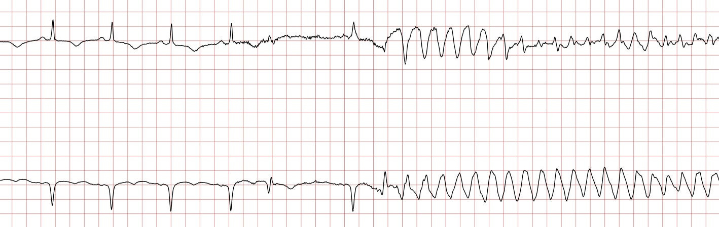 Ventricular tachycardia (VT): ECG criteria, causes, classification,  treatment – The Cardiovascular