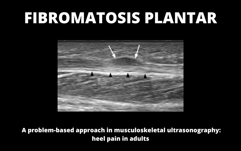 CL Fibromatosis Plantar Ecografia.png