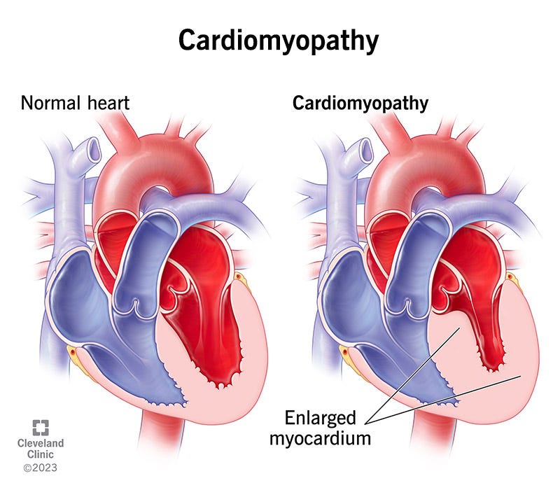 Cardiomyopathy: Symptoms & Treatment