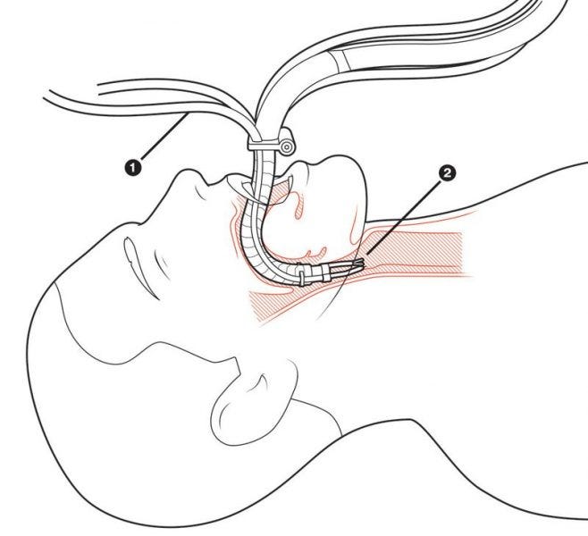 robot being inserted into patients mouth for suergery