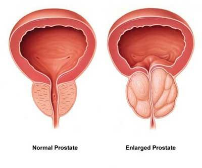 Enlarged Prostate / BPH - AAUrology