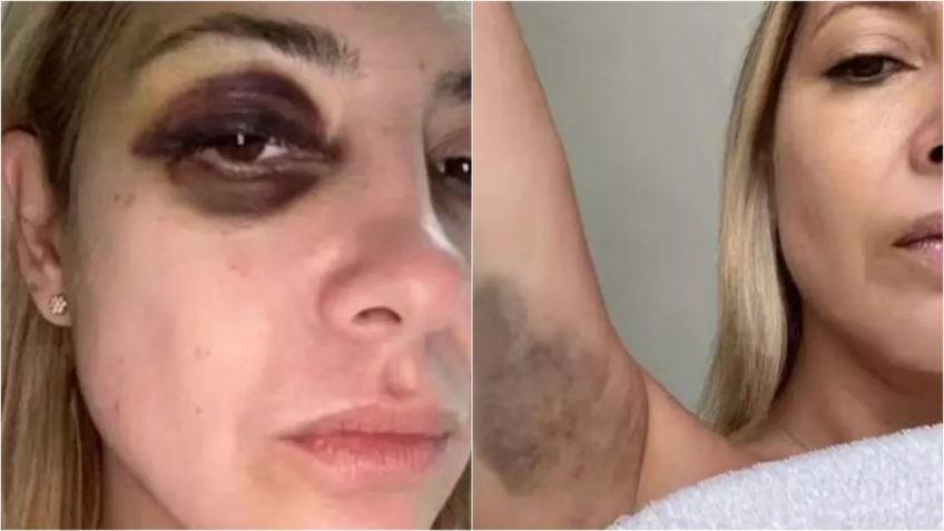 Imprensa publica fotos da ex-primeira-dama argentina após agressão