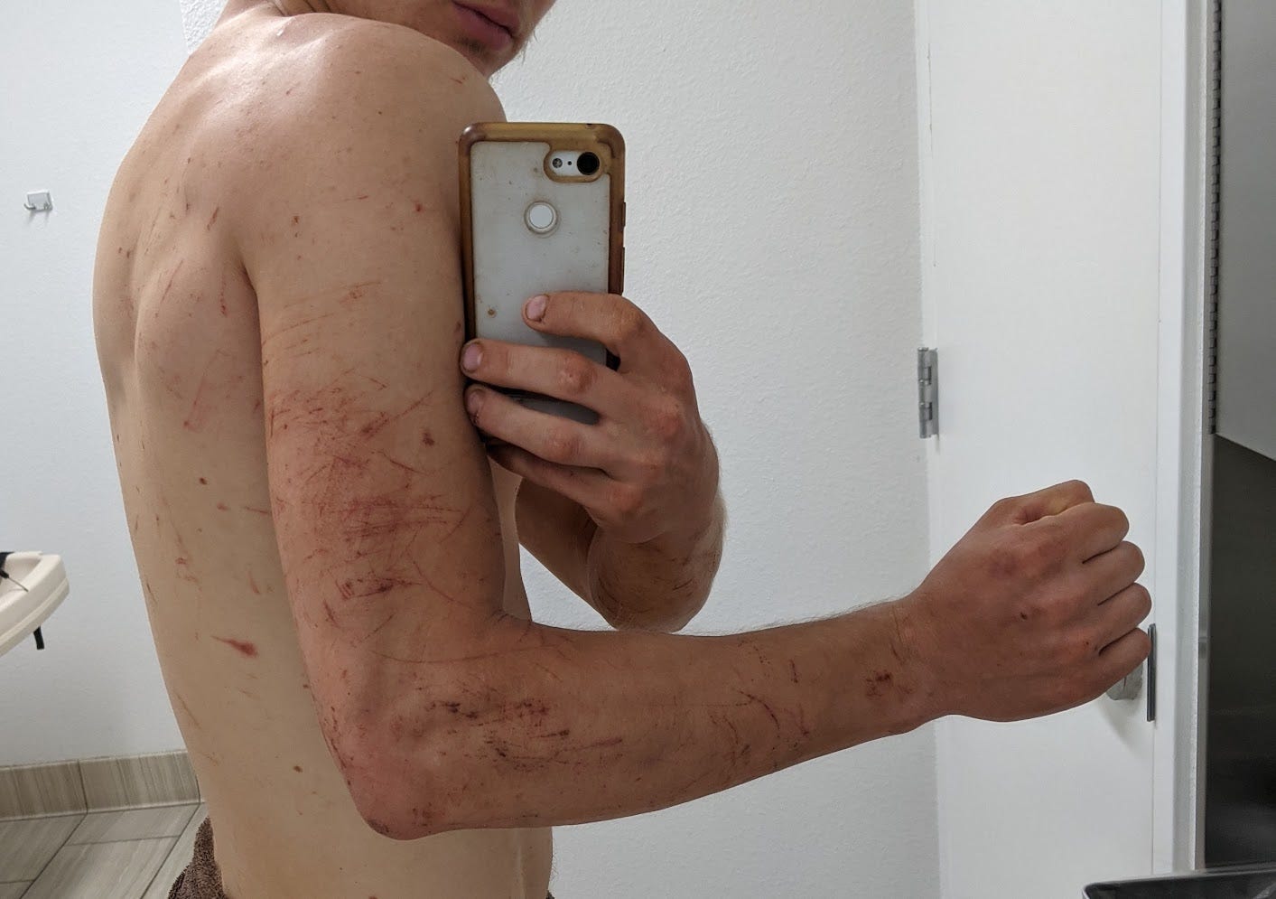 An arm and back with many scrapes all over