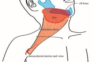 LD flaps successfully restored function and appearance in all 22 cases of complex head and neck reconstruction.