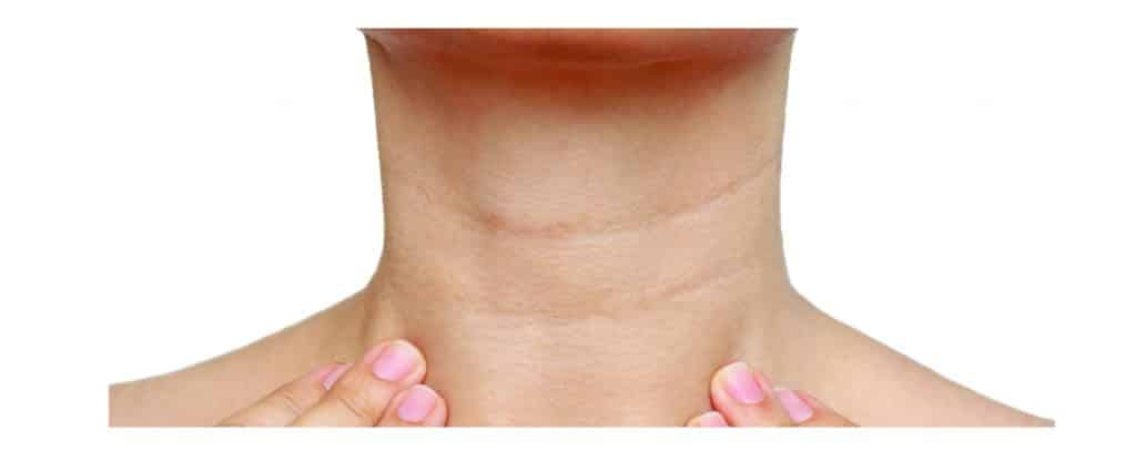 Treating 'Tech Neck' Lines | Tech Neck Treatment | Collins Cosmetic Clinic