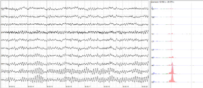 Electroencephalography - Wikipedia