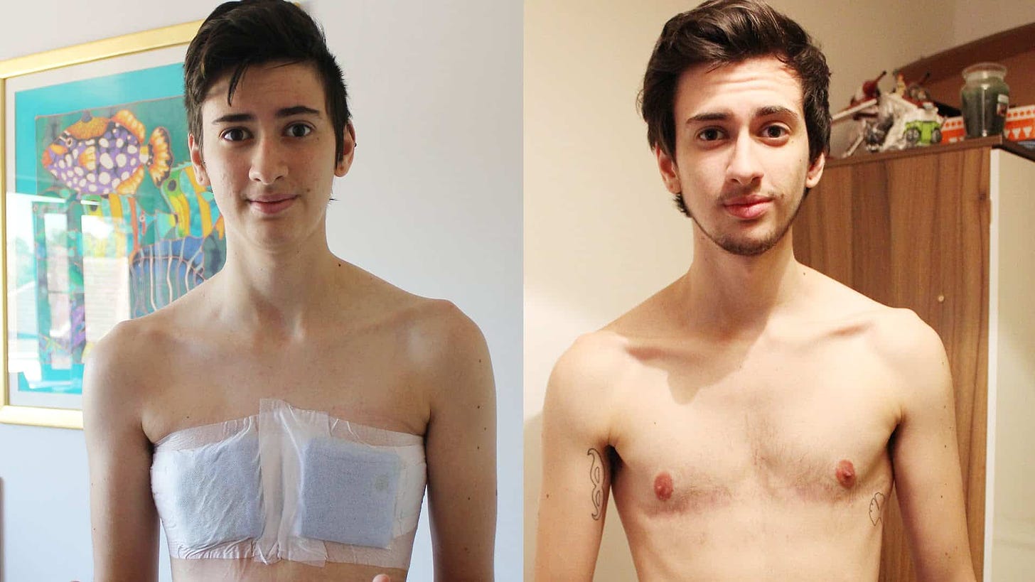 What it’s Really Like to Have Female to Male Gender Reassignment ...