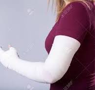 Closeup Of Young Girl With Broken Arm Stock Photo, Picture ...