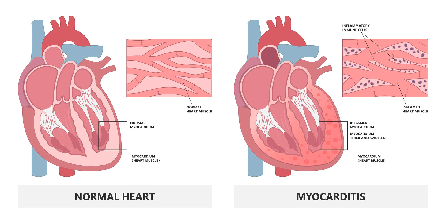 Myocarditis | The Harley Street