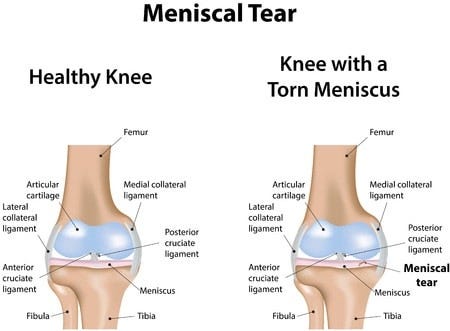 Acute Knee Meniscal Tear - Dr. Dennis Lox Stem Cell Therapy