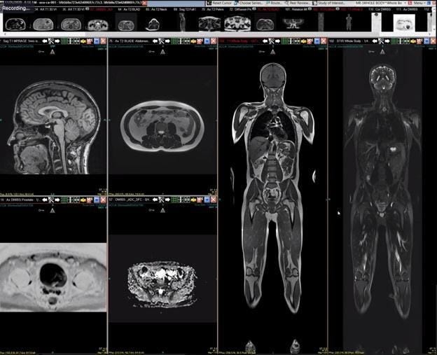 The Latest Quantified Self Trend: Whole-Body MRI