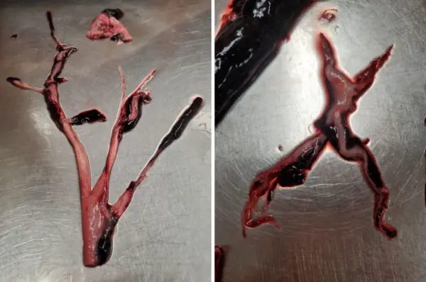 A number of 'parasite 'clots Carolyn pulled from corpses. "Every tentacle is basically down a part of the circulatory system, and at the end of those fingers there is a normal clot, and it looks like they're feeding off it," Carolyn said. (Courtesy of Carolyn)