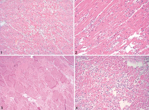 Case A, heart: confluent areas of ischemia (hematoxylin-eosin, original magnification ×100).