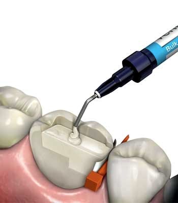 Dental Composites: What to Look For and What to Get - Spear Education