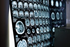 A film of various brain scans seen on a lightbox on a wall