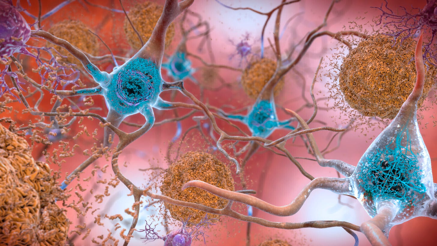 This illustration depicts cells in an Alzheimer’s affected brain
