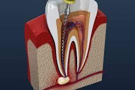 Root Canal vs. Crown: How Are They Different? -