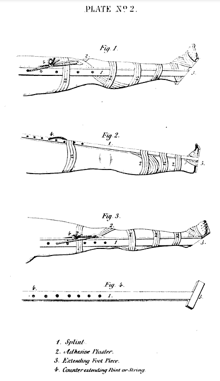 Swinburne's splint designs