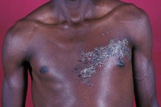 Shingles rash shown on dark brown skin. Blisters are grey and in a cluster on 1 side of a person’s chest. Shingles rash shown on dark brown skin. Blisters are grey and in a cluster on 1 side of a person’s chest.