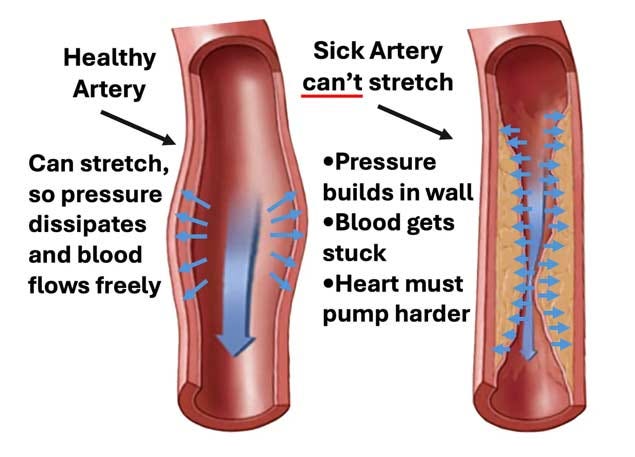 healthy sick artery