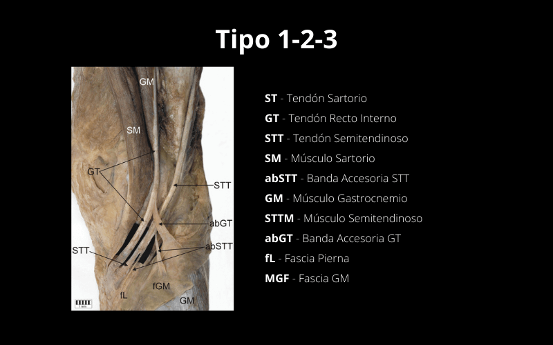 Tipo 123 Pata Ganso Ecografia.png