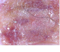 Morgellons Disease is Not a Delusion, Says New Study