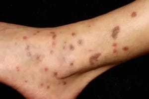 Mayo Clinic researchers have identified a targeted therapy that could bring relief to people living with lichen planus, a chronic inflammatory skin condition of the skin, hair, nails, mouth and genitals.