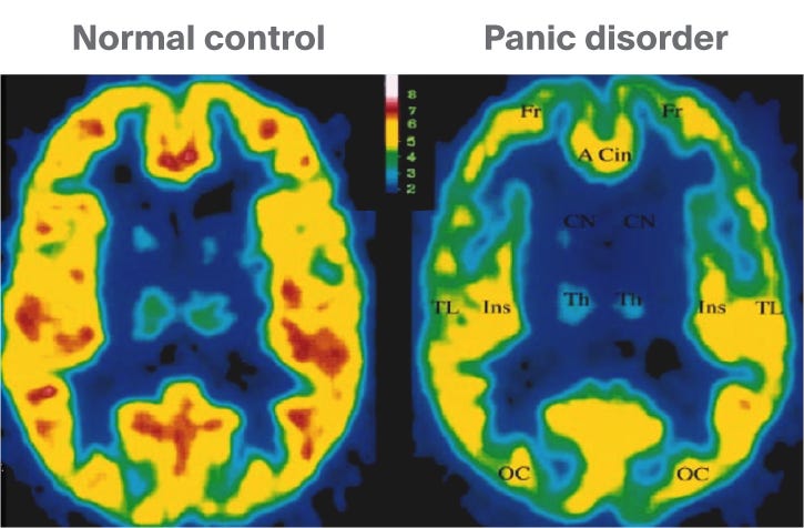Brain Imaging for Psychiatrists, Part 2: Structural (Static) Measures -  Neurotorium