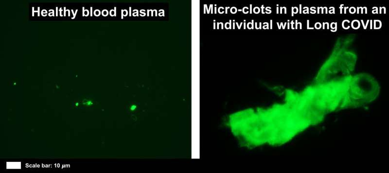 First evidence of inflammatory micro clots in blood of individuals ...