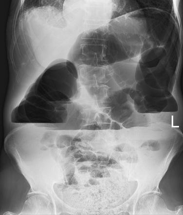 Fecal impaction | Radiology Reference Article | Radiopaedia.org