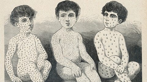 Alamy From left-right, drawings of measles, scarlet fever, and smallpox (Credit: Alamy)