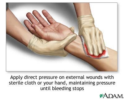 Stopping bleeding with direct pressure: MedlinePlus Medical Encyclopedia  Image